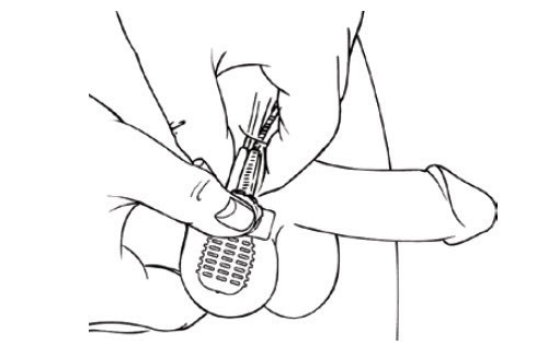 Your Implant Design