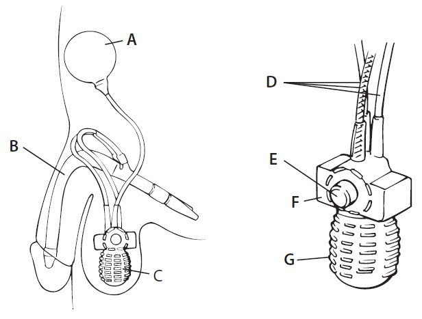 Your Implant Design